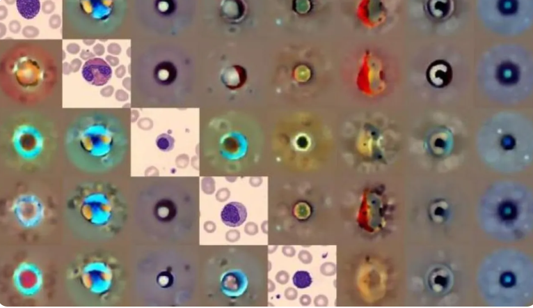 ذكاء اصطناعي يكتشف تشوهات خلايا الدم بدقة تتجاوز الأطباء