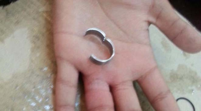 مستشفى سعودي يرفض تخليص فتى من خاتم عَلِق بإصبعه