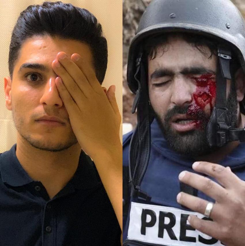 محمد عساف يغطي عينه تضامناً مع الصحافي الفلسطيني معاذ عمارنة