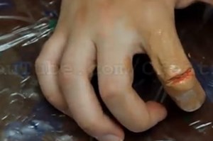 بالفيديو ..  2 مليون مشاهدة لخدعة الإصبع المكسورة والمعلقة