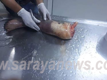 الزرقاء : صور صادمة  ..  دخل المستشفى على اثر جلطة دماغية واستيقظ مبتور القدم بسبب عدم توفر الاسرة 