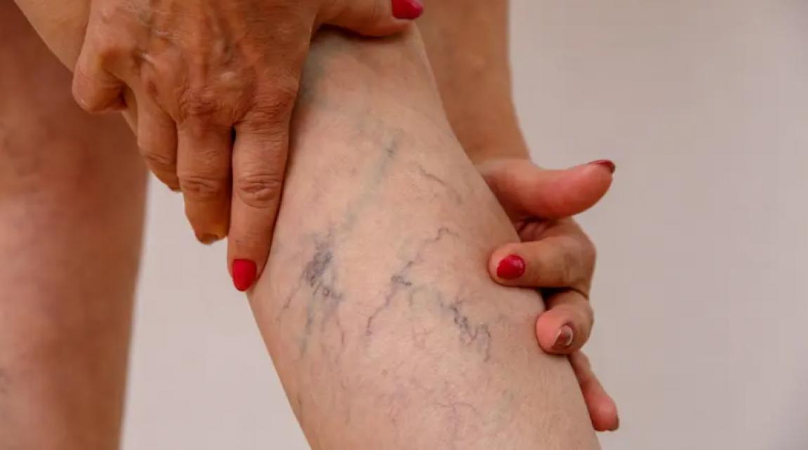 هل تقف أو تجلس طويلًا؟  ..  عادات يومية قد تزيد خطر دوالي الساقين