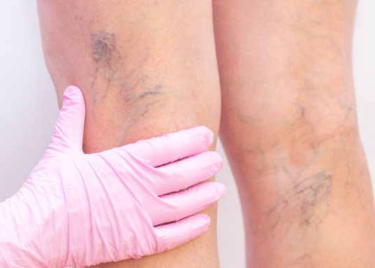 دوالي الساقين ..  متى تتحول إلى جلطة؟