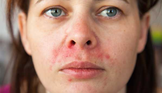 اكزيما الوجه: أهم الأعراض والعلاجات وطرق العناية