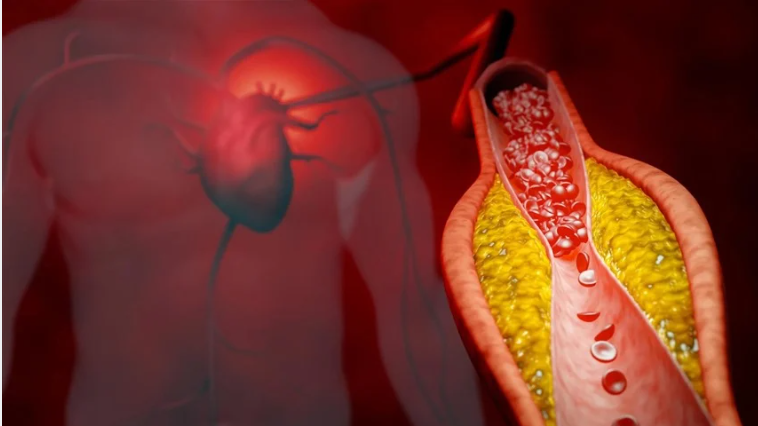 3 طرق لخفض الكوليسترول بدون أدوية ستاتين