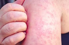 "الصحة الأمريكية تحذر من تفشي الحصبة مع اتساع فجوات التطعيم