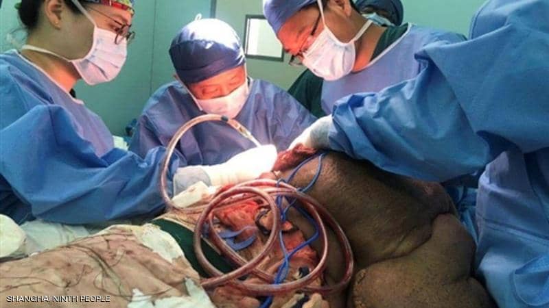 بالصور ..  33 ساعة لإنقاذ رجل من ورم سرطاني وزنه 28 كيلوغراما