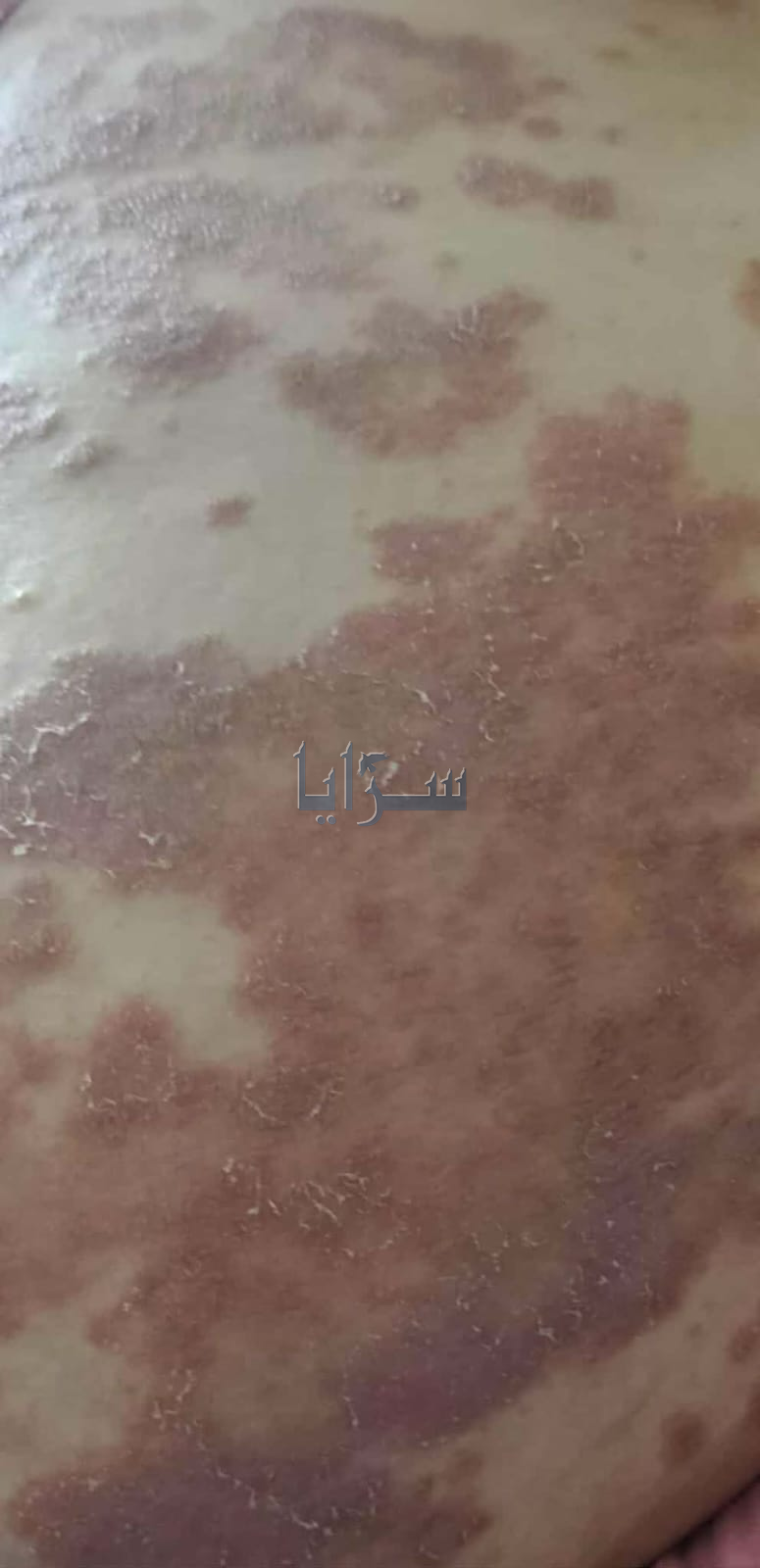 أمام الجهات المعنية  .. مناشدة إنسانية لتوفير تكاليف علاج ليزر لسيدة تعاني من مرض غامض