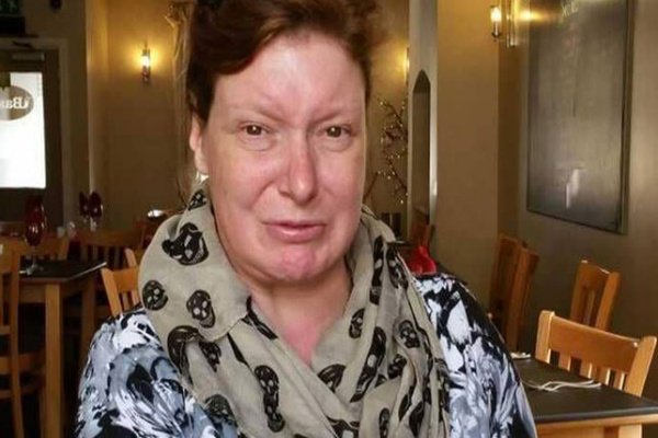 امرأة بريطانية لم تبتسم منذ 35 عامًا