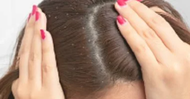 4 وصفات طبيعية تخلصك من القشرة من غير ما تنشف شعرك