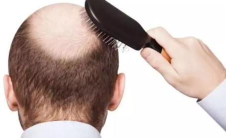 اكتشاف السبب "الدقيق" لتساقط الشعر ما يعد بعلاجات جديدة للصلع