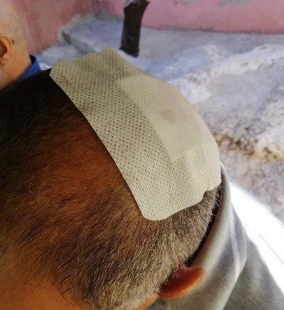 "رصاصة توجيهي" تصيب مواطناً في رأسه الساعة الخامسة فجراً