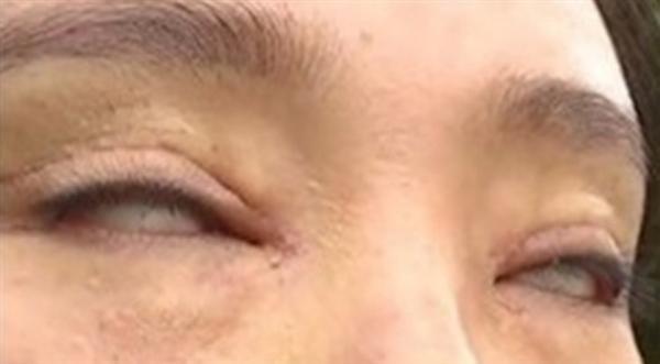 عملية تجميل  ..  تحرمها من إغلاق عينيها