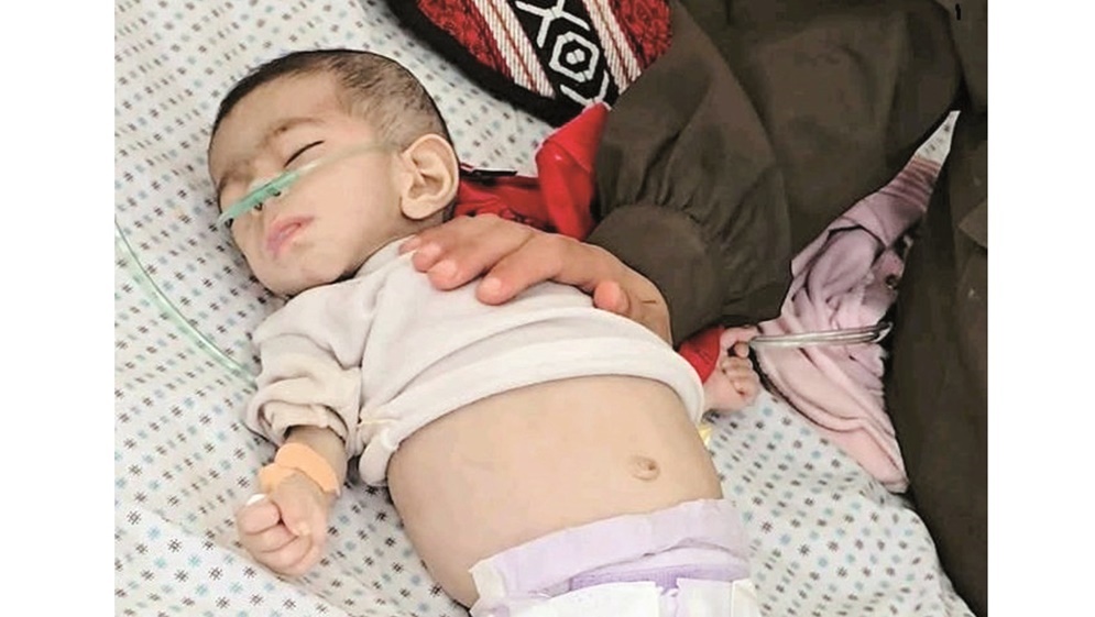 أطفال غزة يتساقطون جوعا ..  51 قضوا والمأساة مستمرة