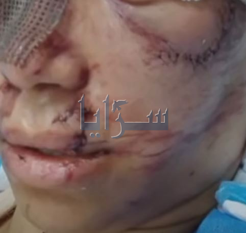 نرمين أبو سرية تصارع الموت في مستشفى البشير وتحتاج ألفي دينار لإجراء عملية عاجلة ..  صور