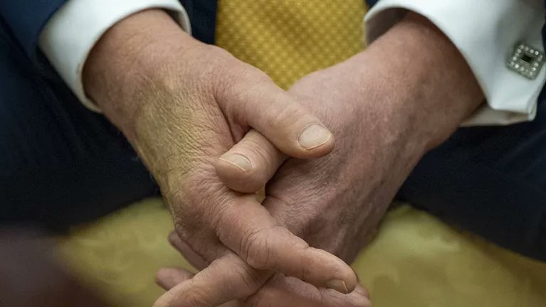 بعد تشخيص إصابة ترامب بالمرض ..  ماذا نعرف عن القصور الوريدي المزمن؟