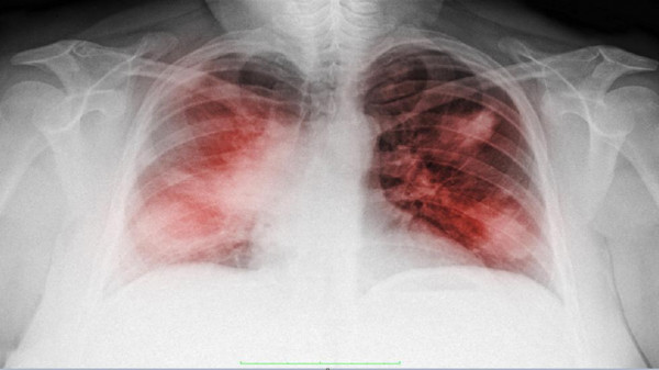 ثلاث علامات تحذيرية غير معتادة قد تكشف الإصابة بسرطان الرئة