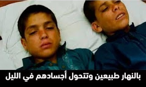 بالفيديو .. هذا التوأم يبدوان طبيعيين في النهار ولكن في الليل تتحول أجسادهم !!