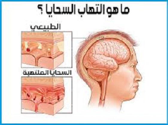 تعرفوا الى التهاب السحايا … انواعه واسبابه واعراضه وطرق علاجه