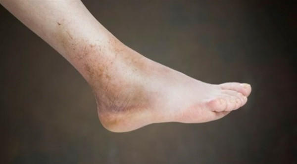 طرق طبيعية لعلاج تورم القدمين