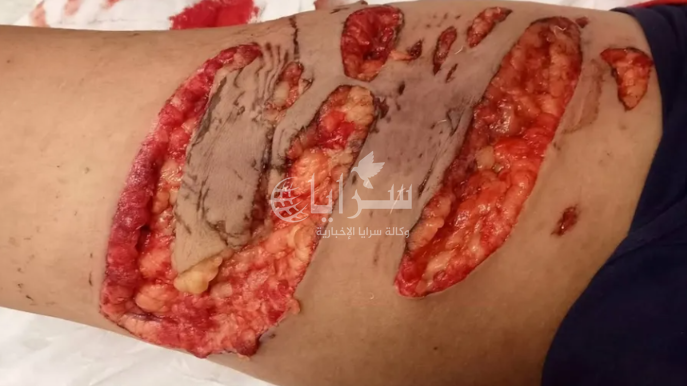 صور صادمة  ..  كلب ينهش طفلًا شمال إربد 