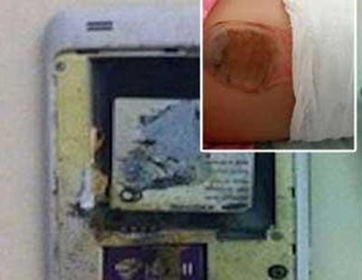 بالصور ..  هاتف ذكي ينفجر في جيب طفلة