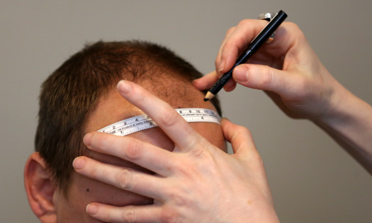 "عملية زرع شعر" تكلف شاب هندي حياته 