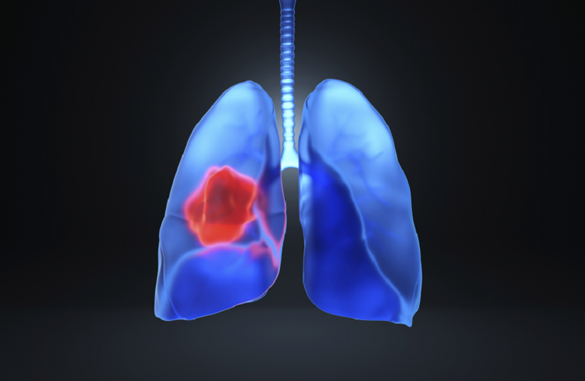 اكتشاف المحرك الرئيسي لتطور سرطان الرئة في مراحله المبكرة