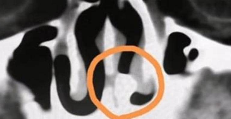 مفاجأة بعد 20 عام  ..   طبيب يكشف سبب انسداد في انف مريض لم يتوقعه احد