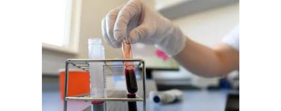 نتائج مشجعة لاستخدام بلازما الدم في علاج مرضى كورونا وتسجيل شفاء حالتين في النمسا