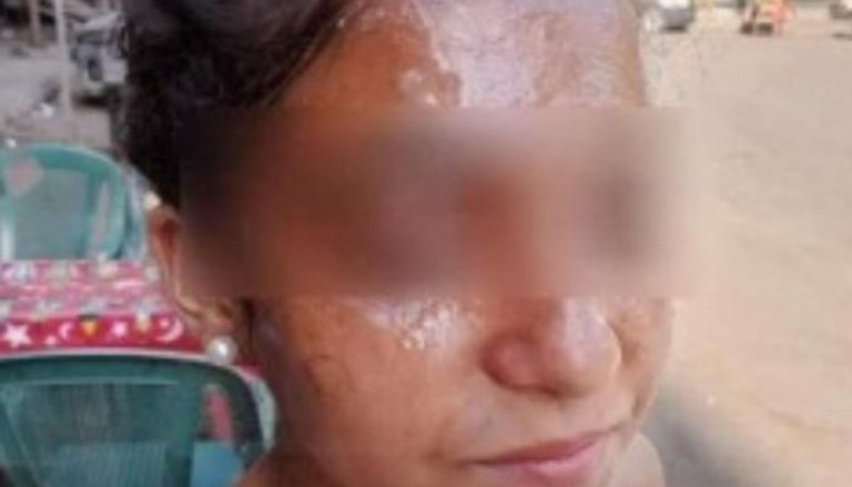 مأساة كارولين «طالبة فيصل» ..  معلمة مصرية تحرق وجه تلميذة بمياه مغلية