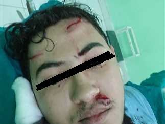 استدرجوه عبر الانترنت لشراء عدسة كاميرا فعاد بـ29 غرزة في الرأس "تفاصيل"