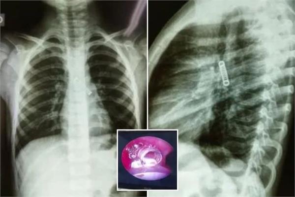 طبيب يعثر على «قطعة حديدية» داخل رئة طفل  