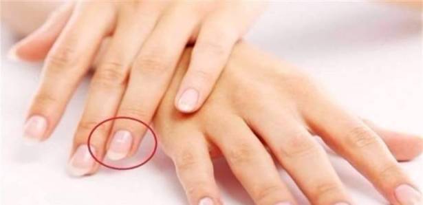 قد تدلّ على مرض بالقلب ..  لماذا تظهر بقع بيضاء على الأظافر؟
