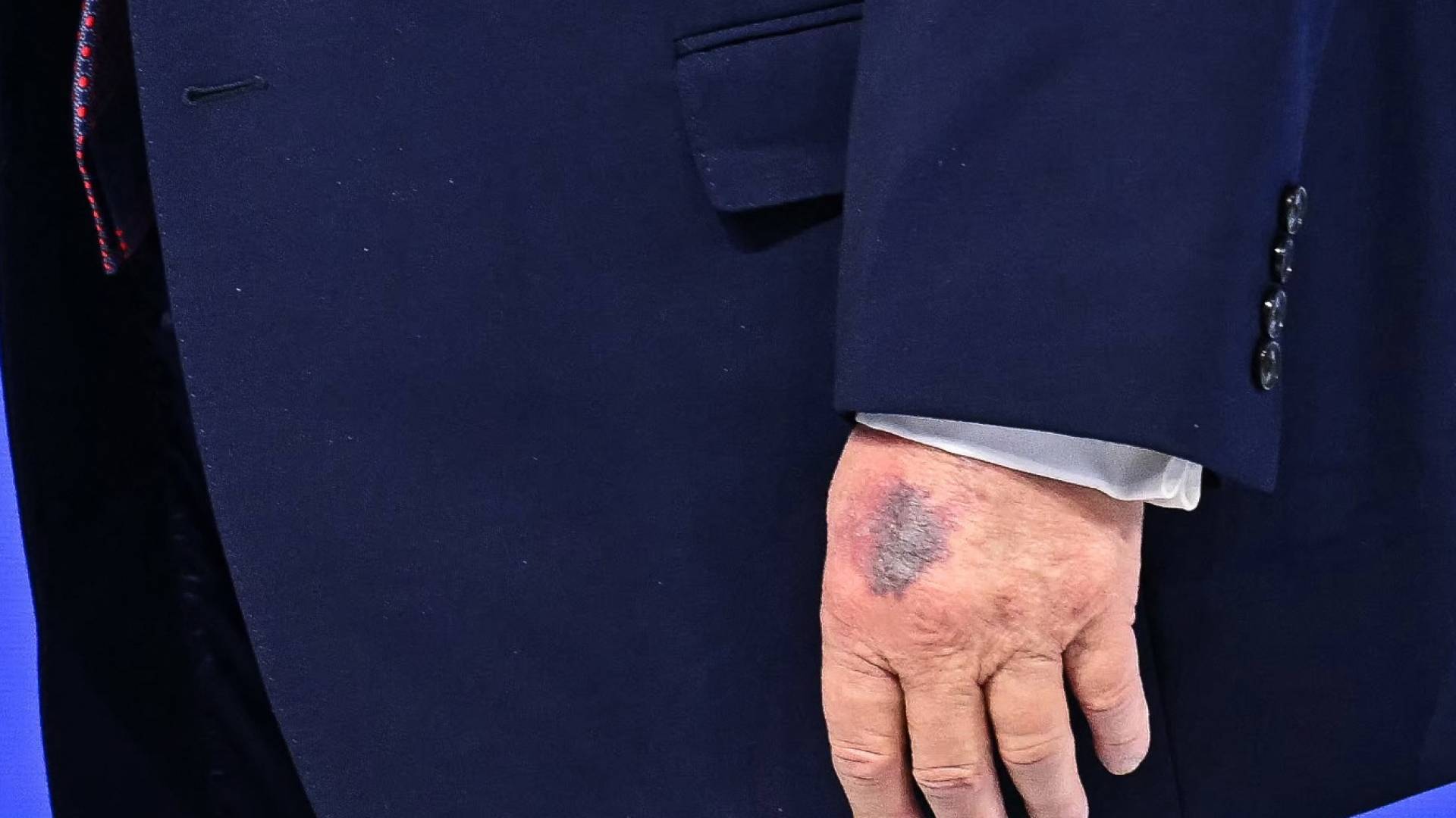 "كدمة غامضة" على يد ترمب اليسرى تخطف الأنظار في دافوس