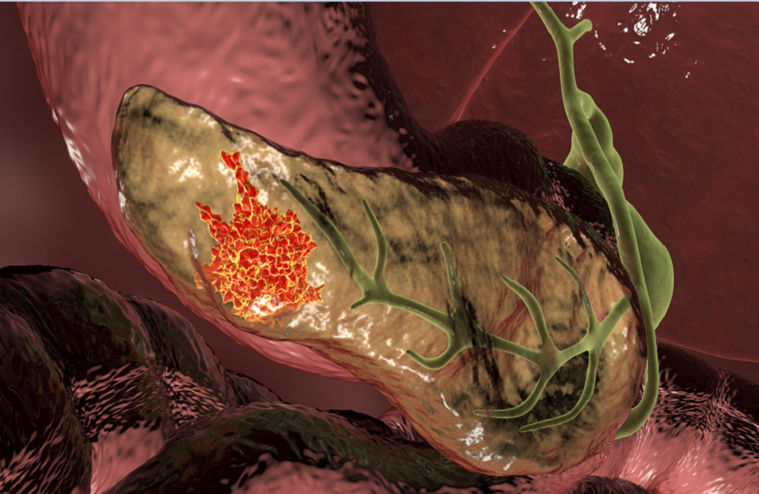 تجربة دوائية رائدة تحقق "اختفاء دائما" لسرطان البنكرياس