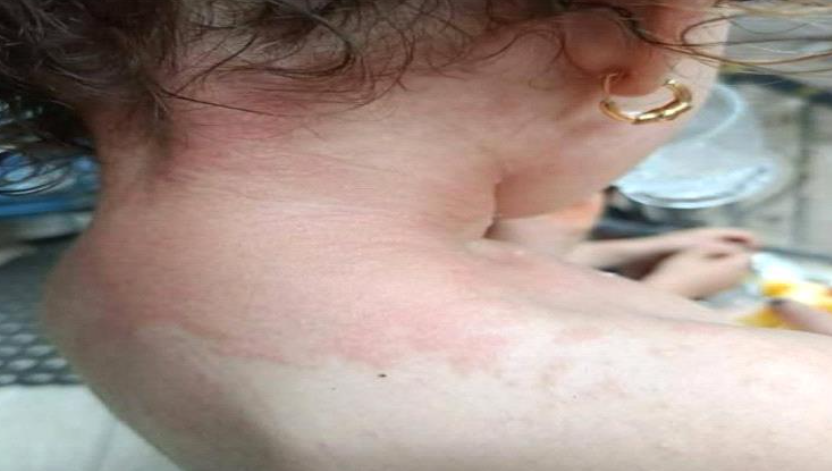 احتراق طفلة بجحيم الصيف في قرية عدن 