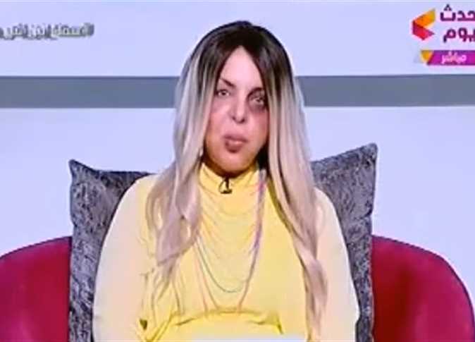 بالفيديو .. مذيعة  مصرية  تظهر بآثار ضرب واعتداء جسدي على وجهها 
