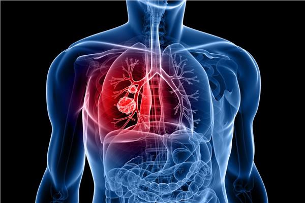 أعراض سرطان الرئة وطرق علاجه