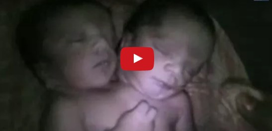 بالفيديو ..  طفل يولد برأسين في الهند