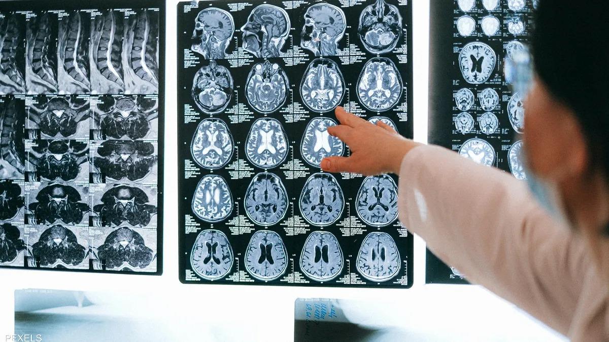 دراسة تكشف تأثير كورونا المرعب على المخ والذاكرة