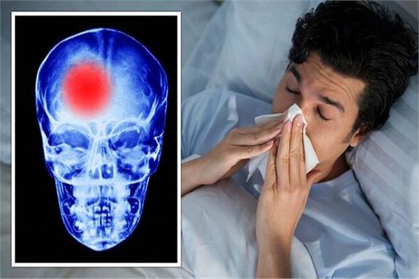 دراسة أمريكية: الإنفلونزا مرتبطة بزيادة خطر الإصابة بالسكتة الدماغية