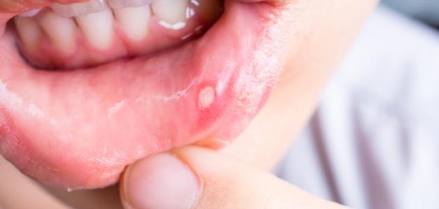 اكتشف أنواع من السرطان تهدد سلامة الفم