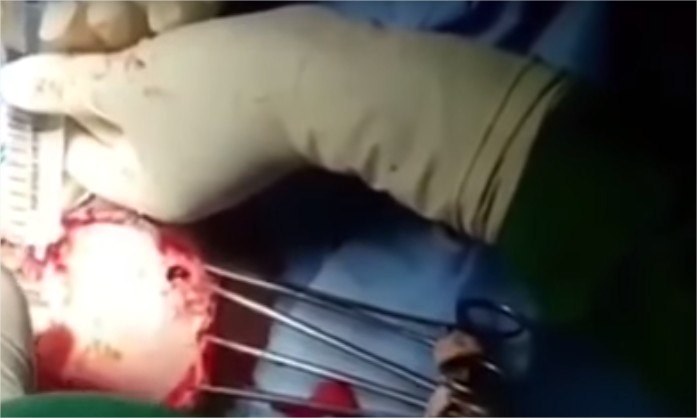 بالفيديو ..  أطباء يُجرون جراحة مخ لمريضة مستيقظة تشاهد فيلمًا