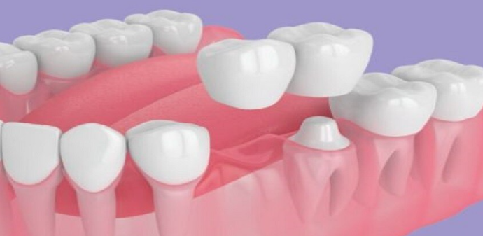 روسيا ..  ابتكار بديل رخيص لزراعة الأسنان